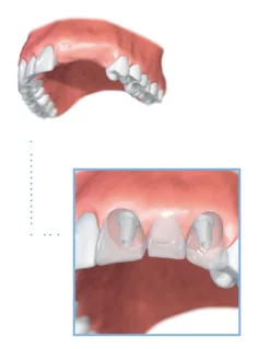 Multiple tooth dental implants illustration